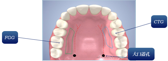 CTG（結合組織移植片）の採取部位