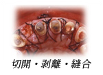 切開・剥離・縫合